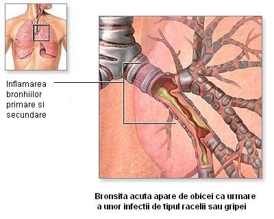 imagini bronsita acuta